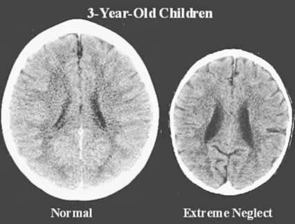 brain-scans-show-the-real-impact-love-has-on-a-childs-brain-1